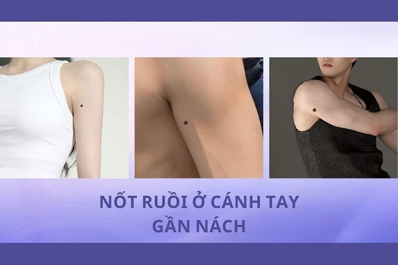 Nốt ruồi ở cánh tay gần nách cảnh báo nhiều biến cố