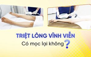 Lý do triệt lông vĩnh viễn những vẫn mọc lại