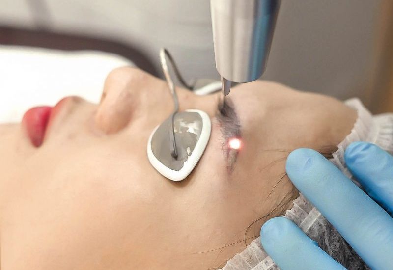 Kỹ thuật mài da cũng khá hiệu quả, nhưng không bằng phương pháp laser